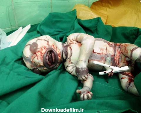 تولد یک نوزاد با یک بیماری وحشتناک در ایران+تصاویر(+18)