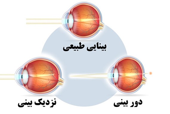 اصلاح عیوب انکساری - مرکز چشم پزشکی سلامت غرب تهران