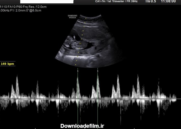 قلب جنین چه زمانی تشکیل می‌شود؟ - موسسه رادیولوژی و سونوگرافی آوا