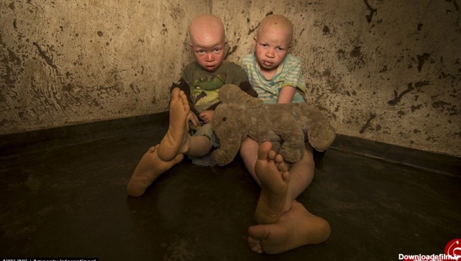 سرنوشت وحشتناک کودکان زال + تصاویر