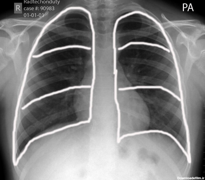 مشاهده دقیق وضعیت ریه با انجام رادیوگرافی سینه
