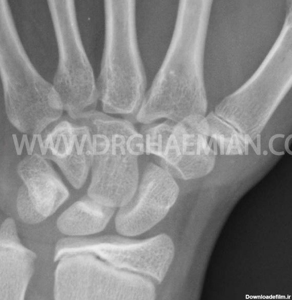 رادیولوژی مچ دست - دکتر قائمیان | مرکز تصویر برداری پزشکی دکتر قائمیان