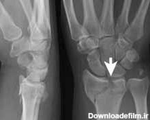 شکستگی مچ دست (کالیس). علائم و درمان - ایران ارتوپد