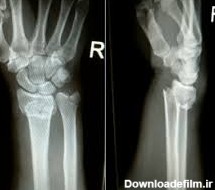 شکستگی مچ دست – کلینیک دست و شانه