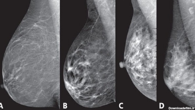 تفسیر نتایج آزمایش ماموگرافی - رادیولوژی و سونوگرافی تشخیصی ...