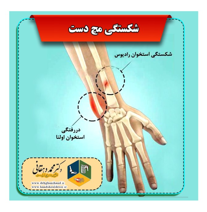 شکستگی، درمان و علایم مچ دست (کالیس) | دکتر محمد دهقانی دکتردهقانی ...