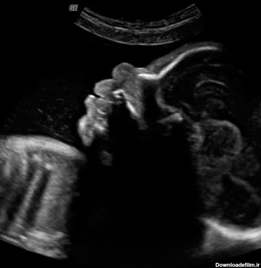 سونوگرافی هفته بیست و نهم بارداری و در آن چه می بینید؟ | نی نی پلاس