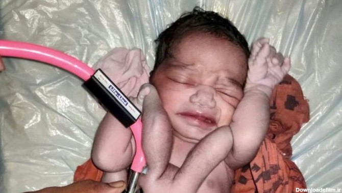 تولد نوزاد عجیب‌الخلقه در هند/واکنش هندی ها چیست؟+عکس