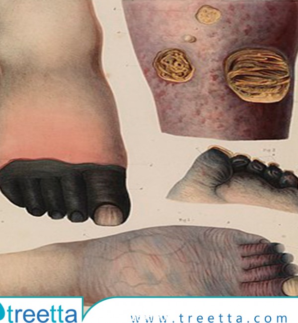 بررسی سیاه شدن پا در اثر دیابت|کنترل و درمان - تریتا