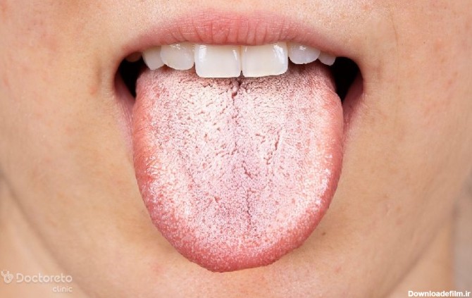 برفک دهان چیست و روش درمان آن چگونه است؟ – مجله سلامت دکترتو