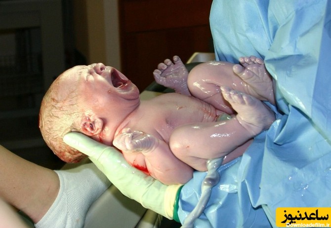 تولد عجیب ترین نوزاد جهان با هاله ای شیشه ای دور سرش+عکس جنین