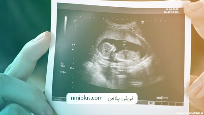 سونوگرافی در هفته اول بارداری چه چیزی را نشان می دهد؟ | نی ...
