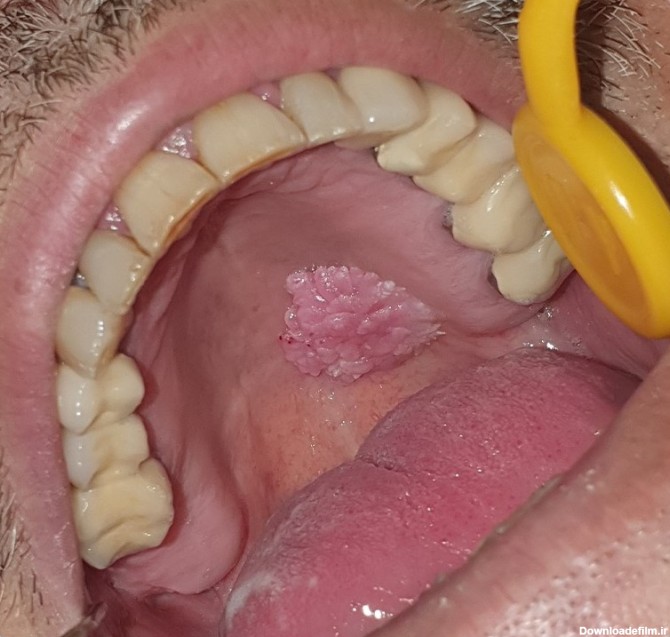 زگیل دهانی یا HPV دهانی چیست؟ علائم زگیل تناسلی در دهان، راه ...