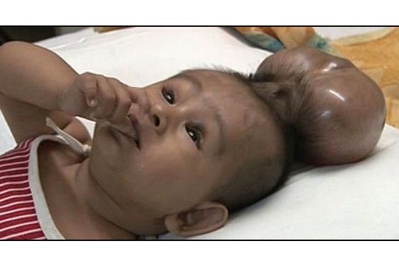 جراحان سر دوم کودک 8 ماهه هندی را جدا کردند (+عکس)