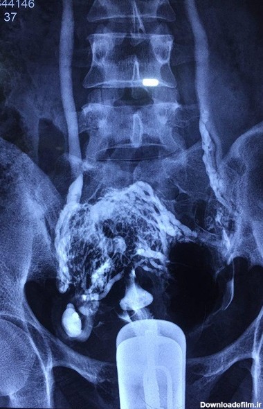 هيستروسالپنگوگرافي با ماده حاجب یکی از انواع عکسهای رادیولوژی با ...