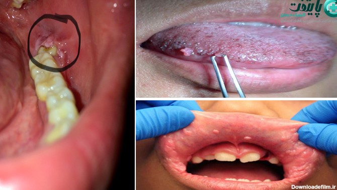 زگیل دهانی چیست؟ عوامل خطر، تشخیص و درمان HPV در دهان ...