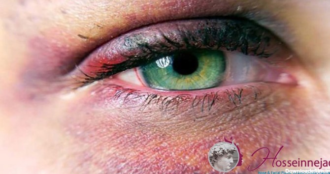 کبودی چشم بعد از جراحی بینی( رینوپلاستی)| رفع کبودی بعدازعمل ...