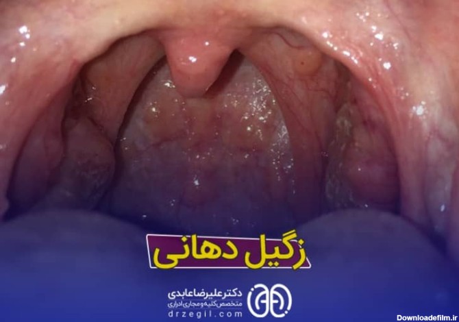 زگیل دهانی از علائم تا درمان - دکتر علیرضا عابدی