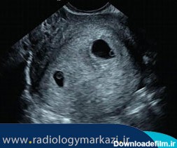 سونوگرافی تشخیص بارداری یک یا چند قلویی در اصفهان