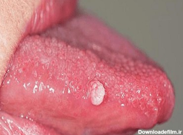 زگیل دهانی (زگیل تناسلی در دهان و گلو) + عکس و نحوه درمان