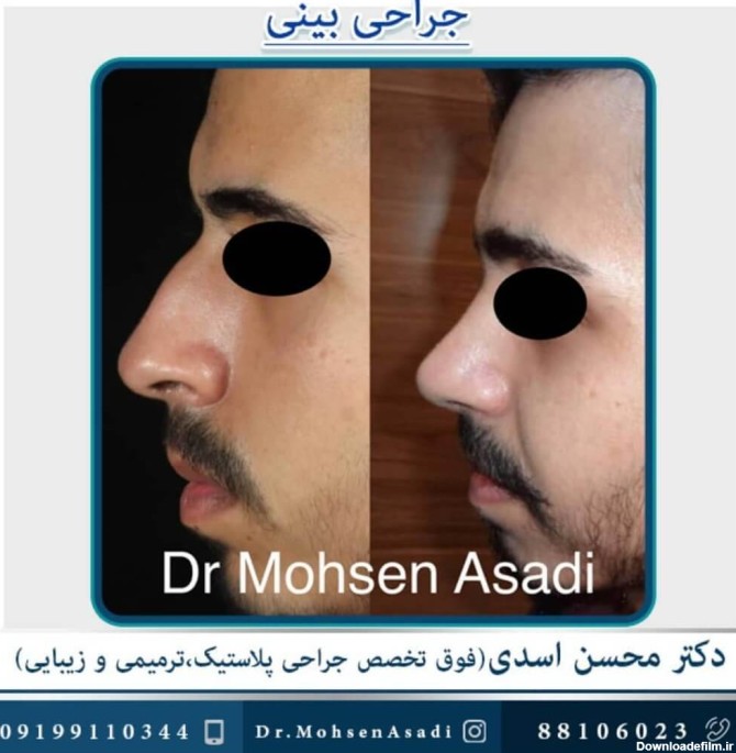 راهنمای کامل جراحی بینی مردانه و بهترین مدل های بینی آقایان | دکتر ...