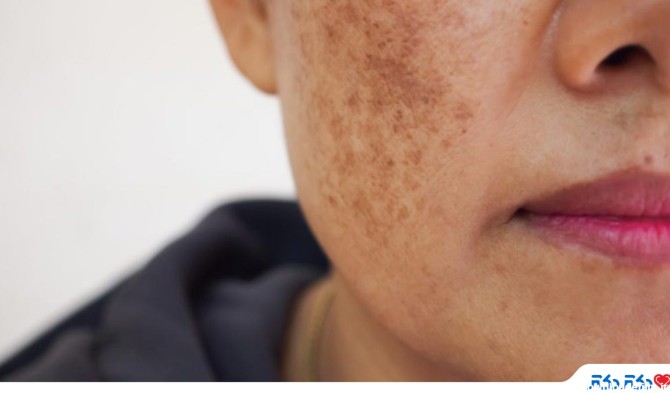 لکه‌های سیاه روی پوست؛ چرا ایجاد می‌شود و راه درمانش چیست؟