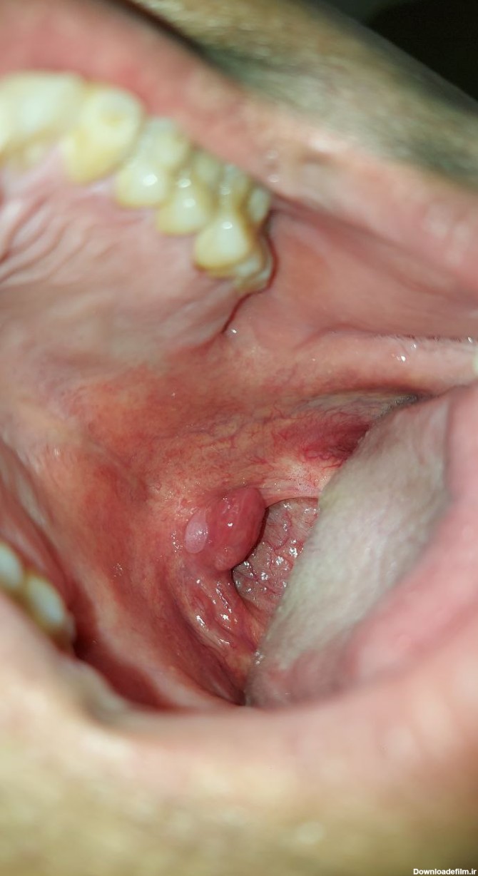 زگیل دهانی را چگونه درمان کنم؟علائم و تفاوت آفت و زگیل دهانی