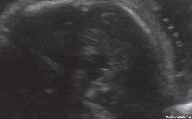 سونوگرافی جنین در هفته 35 بارداری
