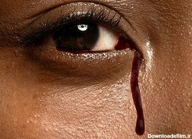 دلایل خون گریه کردن چیست - مجله پزشکی دکتر اشکان