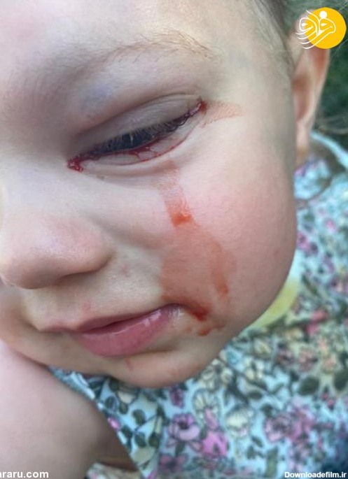 فرارو | (تصاویر) دختربچه‌ای که خون گریه می‌کند!