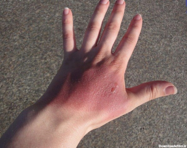 درمان سوختگی دست