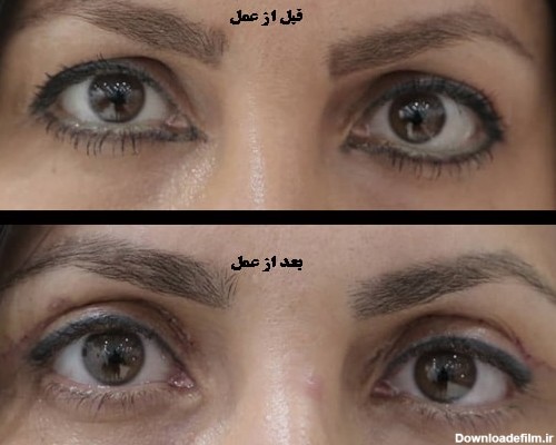 تصاویر نمونه عمل پلک (بلفاروپلاستی) - چشم پزشکی نوآوران