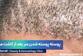 علت و نحوه درمان پوسته های سر بعد از کاشت مو - کلینیک مارال