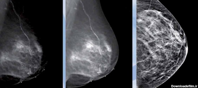 ماموگرافی به چه دردی می خورد؟