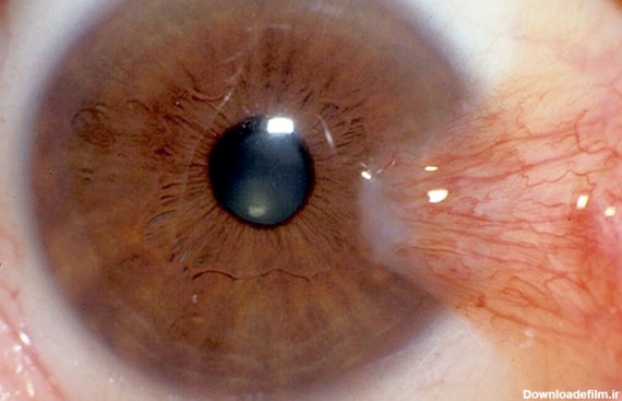 ناخنک چشم (Pterygium)