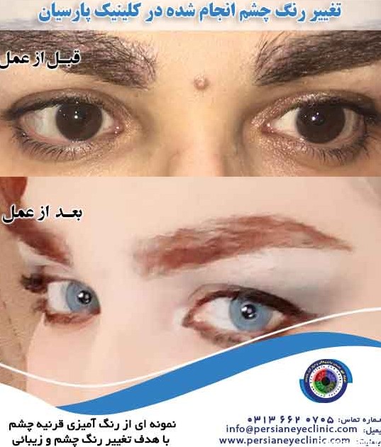 تغییر رنگ چشم، رؤیا یا واقعیت - کلینیک چشم پزشکی پارسیان