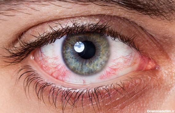 خشکی چشم - Dry Eye Syndrome