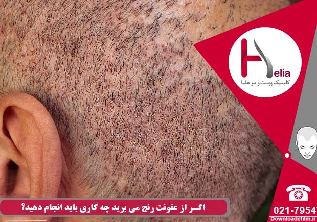 عفونت پس از کاشت مو | بررسی علت، پیشگیری و درمان - کلینیک هلیا