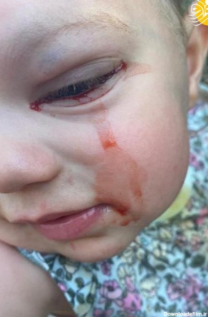 فرارو | (تصاویر) دختربچه‌ای که خون گریه می‌کند!