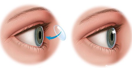 پیوند قرنیه - کلینیک فوق تخصصی جراحی چشم بینا