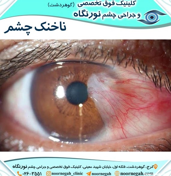 ناخنک چشم | کلینیک فوق تخصصی و جراحی چشم نور نگاه