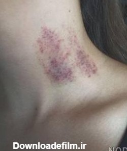 عکس کبودی روی گردن - عکس نودی