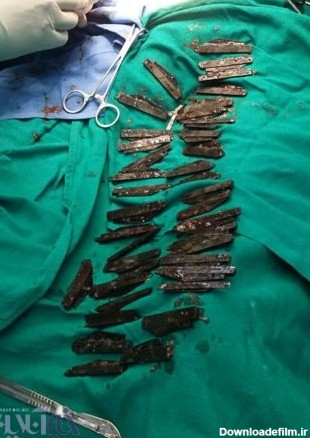 عکس | جراحی ۵ ساعته روی مرد هندی که ۴۰ چاقو بلعیده بود - خبرآنلاین