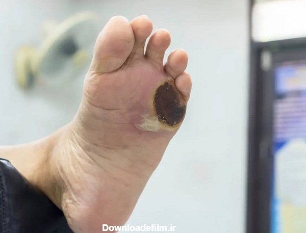 سیاه شدن پای دیابتی - دکتر توفیق فوق تخصص جراحی عروق