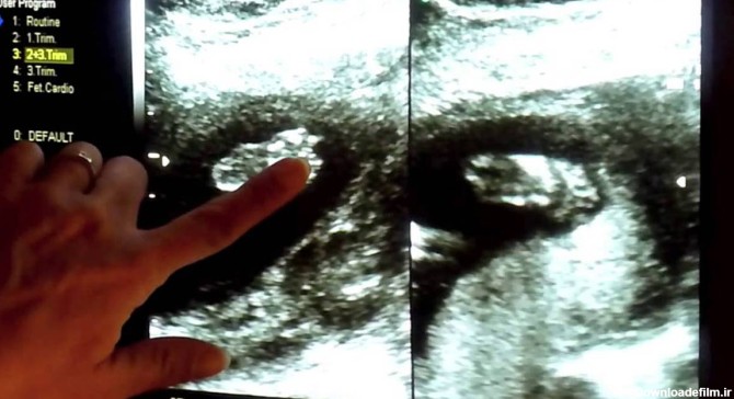تفاوت جنین دختر و پسر در سونوگرافی هفته 12 در چیست؟ + عکس - نبض اول