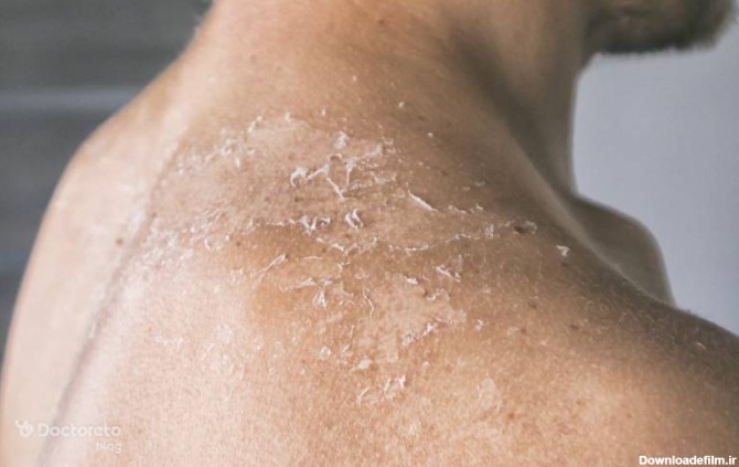 قارچ پوستی چیست؟ علائم، علل و راه های درمان سریع آن