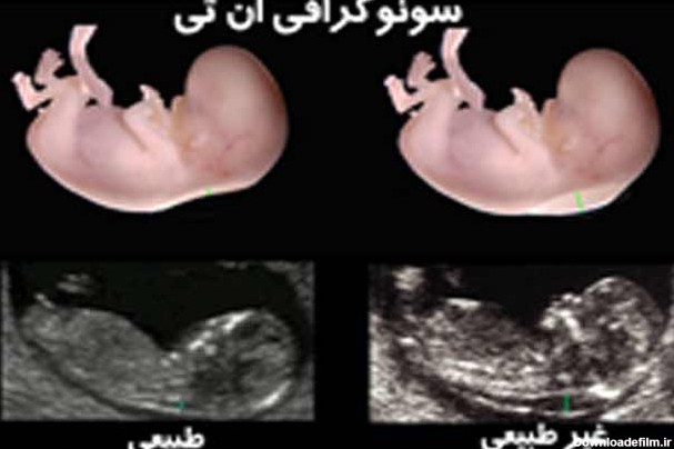 علائم بارداری برای تشخیص سریع حاملگی - دکتر لیلا نعمت اللهی ...