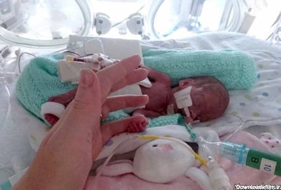نوزاد نارس , زنده ماندن نوزاد 23 هفته ای زیر تیغ جراحی