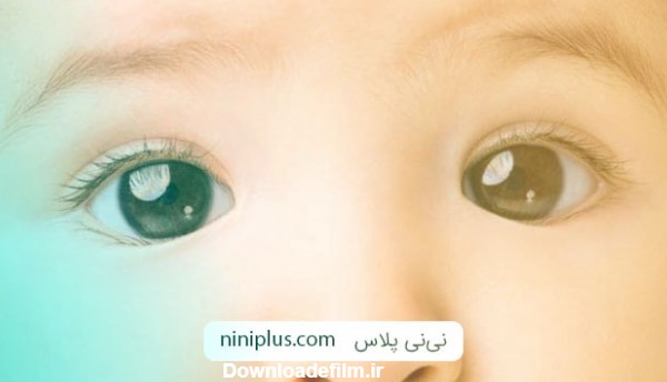 شناخت انواع روش های درمان انحراف چشم نوزاد | نی نی پلاس
