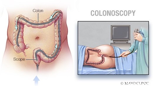 کولونوسکوپی روده بزرگ و کوچک: مراحل انجام و نکات قبل و بعد